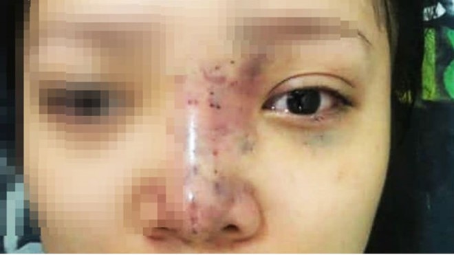 Truy tìm chủ cơ sở spa tiêm filler làm nữ sinh 20 tuổi mù mắt ảnh 1
