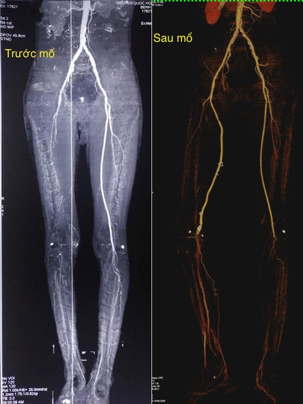 Bàn chân người đàn ông Quảng Nam chết khô vì nghiện thuốc lá ảnh 1