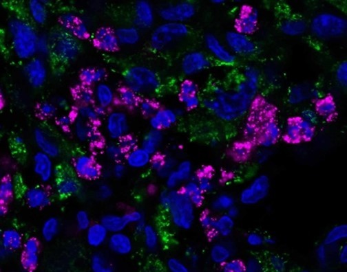 Vi khuẩn gây ngộ độc thực phẩm diệt khối u não ảnh 1