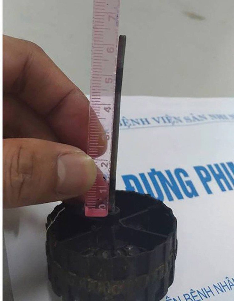 Bé 11 tháng bị trục sắt bánh xe đồ chơi dài 7cm cắm vào đầu ảnh 1