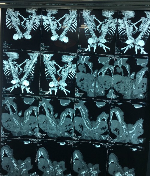 Cặp song sinh dính nhau được bác sĩ Sài Gòn mổ tách thành công ảnh 1