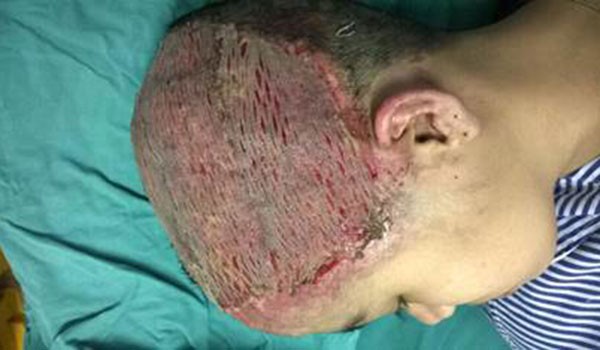 Thiếu nữ bị bỏng nặng vùng da đầu do máy uốn tóc ảnh 1