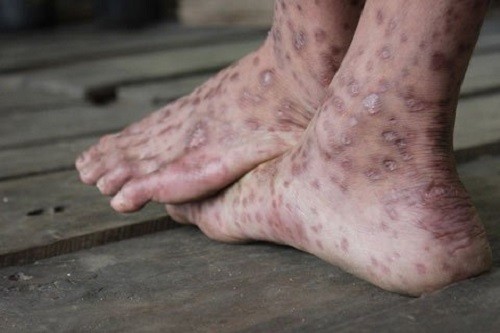 Mùa mưa lũ đề phòng các bệnh về da ảnh 2