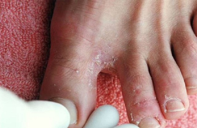 Mùa mưa lũ đề phòng các bệnh về da ảnh 3