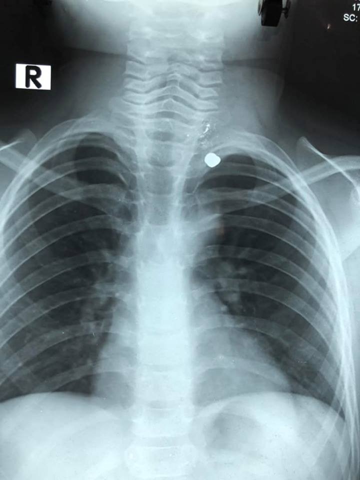 Anh trai nghịch súng bắn xuyên cổ em trai ảnh 1