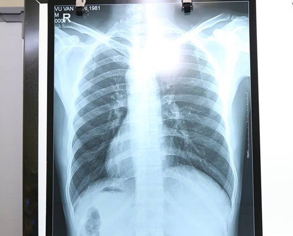 Người đàn ông Hà Nội có tim và dạ dày lộn ngược khiến bác sĩ kinh ngạc ảnh 1