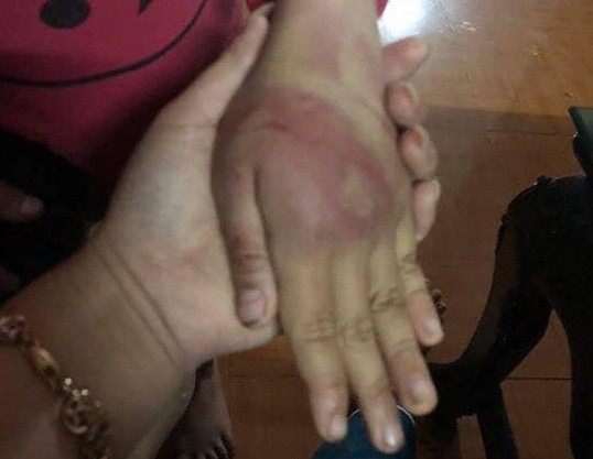 Người bố nghiện ma túy đánh con gái thâm tím người do học kém anh trai ảnh 1