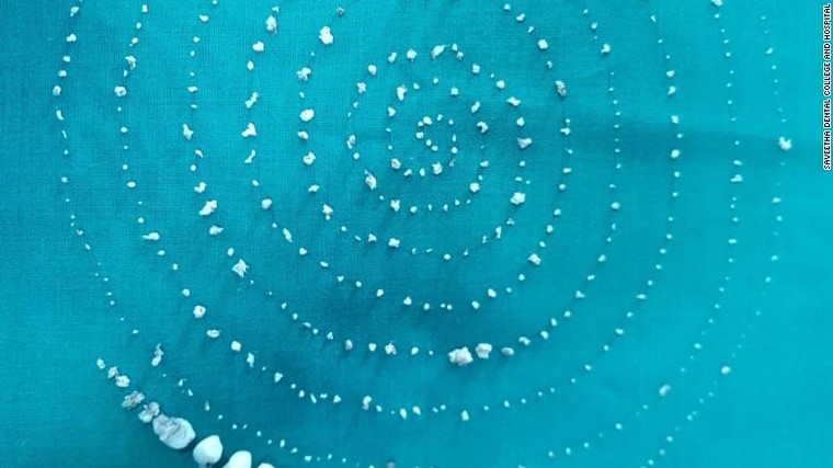 Bác sĩ phát hiện khối u chứa hơn 500 chiếc răng trong miệng cậu bé 7 tuổi ảnh 1