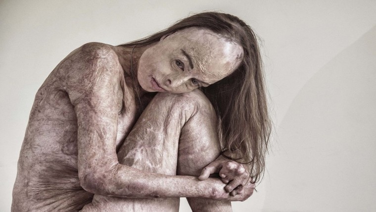 Ảnh người đẹp bị bỏng 85% được chọn tranh giải thưởng Portrait of Humanity 2020 ảnh 1