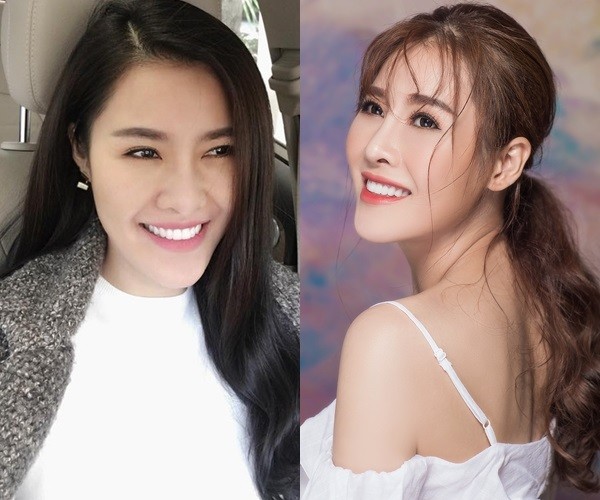 Loạt sao Việt công khai phẫu thuật thẩm mỹ năm 2017 ảnh 3