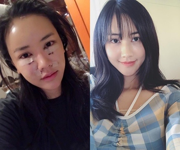 Loạt sao Việt công khai phẫu thuật thẩm mỹ năm 2017 ảnh 4