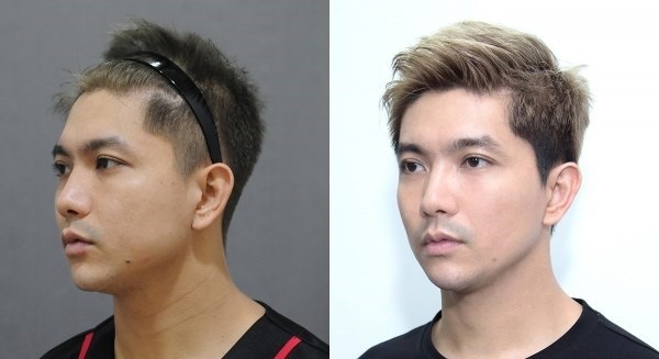 Loạt sao Việt công khai phẫu thuật thẩm mỹ năm 2017 ảnh 6