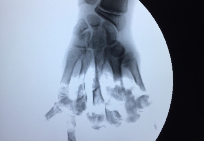 Bé trai 13 tuổi bị máy xay thịt nghiền nát bàn tay ảnh 1