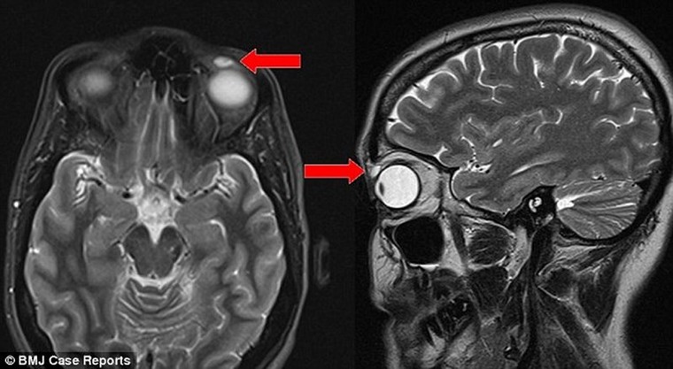 Kính sát tròng nằm trong mắt 28 năm sau va chạm ảnh 1