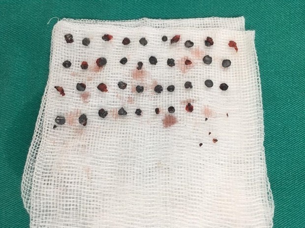 Nam thanh niên bị mù mắt do 50 viên đạn từ súng hoa cải ảnh 1