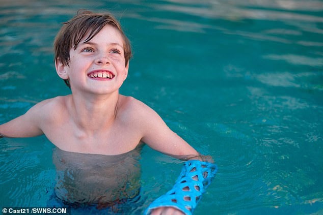 Khuôn bó bột kiểu mới không gây ngứa, không mùi, không cần cắt bằng cưa ảnh 2