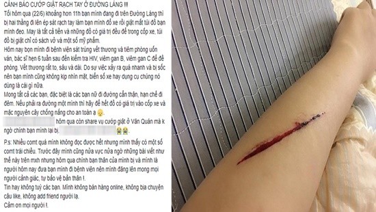 Thật hư câu chuyện về thiếu nữ trẻ bị rạch tay, cướp túi xách trên đường Láng ảnh 1