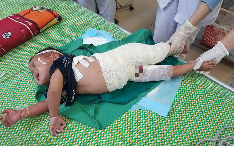 Ngã vào nồi nước sôi, bé trai hơn 2 tuổi đang nguy kịch ảnh 1