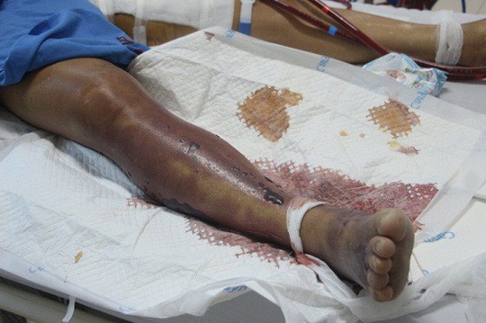 Ăn tiết canh lợn, người đàn ông nhập viện trong tình trạng nguy kịch ảnh 1