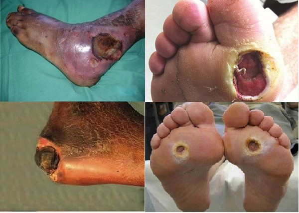 Biến chứng khủng khiếp của căn bệnh cướp mạng gần 30.000 người Việt mỗi năm ảnh 3