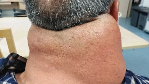 26 năm uống rượu, người đàn ông thành ‘quái vật’ với chiếc cổ kì dị ảnh 1