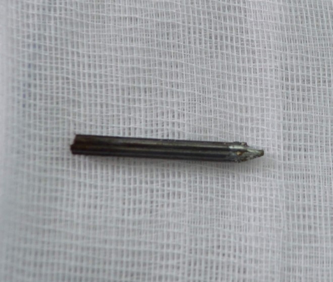 Sửa nhà đón Tết, người đàn ông bị đinh bắn sâu vào hốc mắt ảnh 2