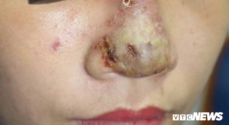 ‘Nát mặt’ vì tiêm chất tan mỡ tạo cằm V-line đón Tết ảnh 2