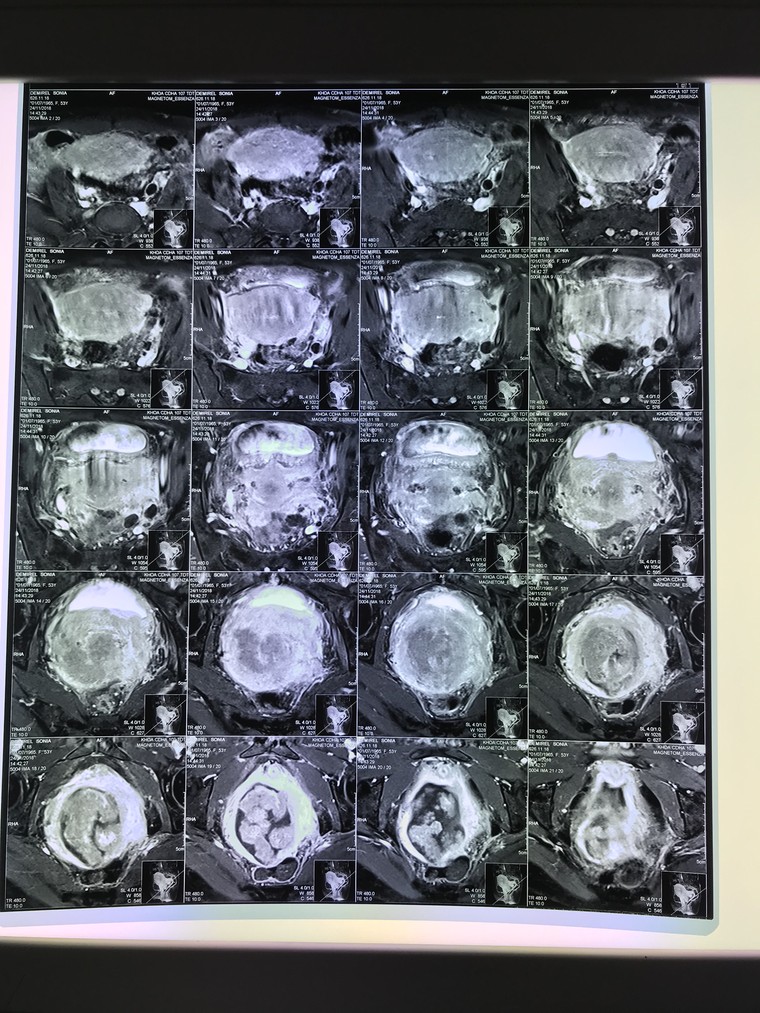 Tầm soát sớm ung thư cổ tử cung như thế nào? ảnh 1