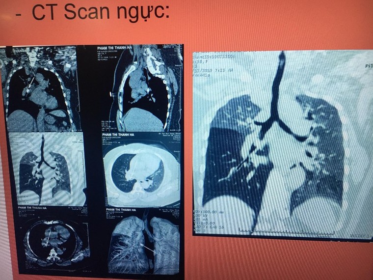 Gắp mảnh xương vịt 'núp' trong phế quản bệnh nhân suốt 10 tháng ảnh 1