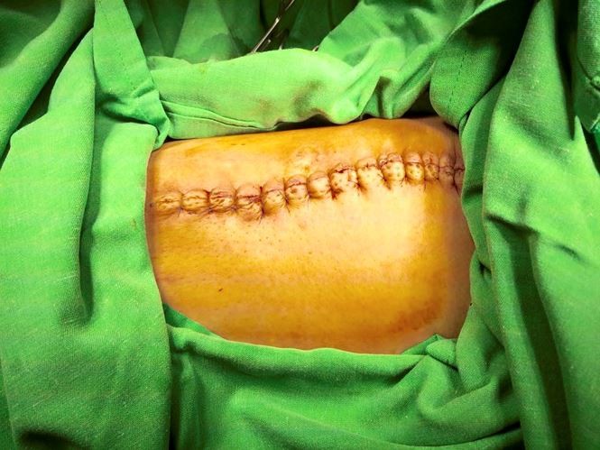 Cắt bỏ thành công khối u nặng 2kg đeo bám người đàn ông suốt 12 năm ảnh 1