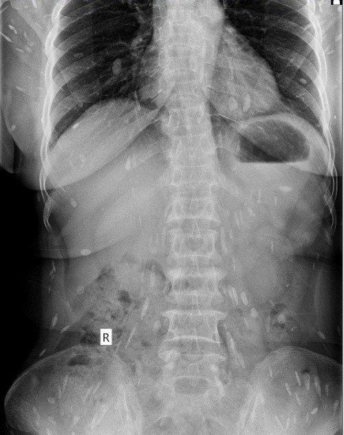 Nhập viện vì sán lá gan sinh sôi khắp cơ thể ảnh 1