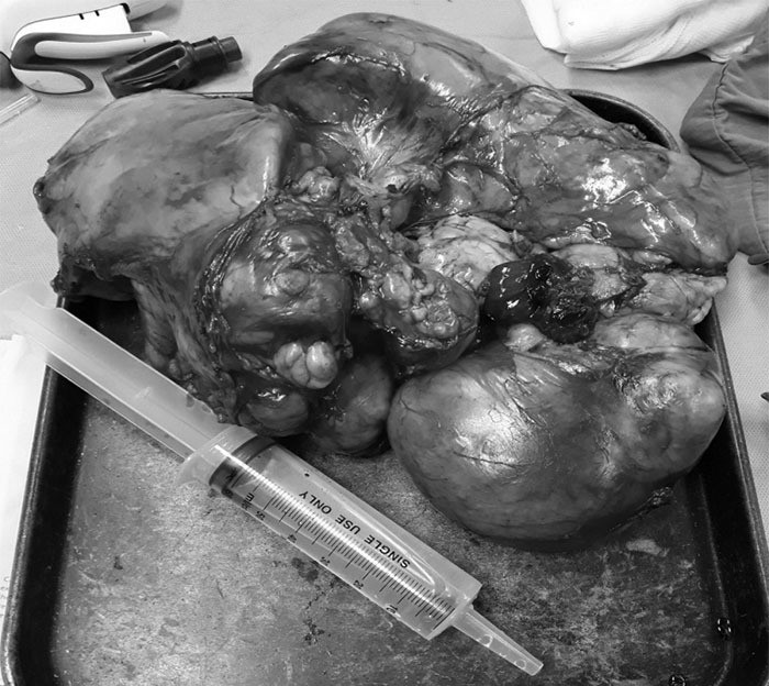 Phẫu thuật thành công khối u trung thất nặng 4kg ảnh 1