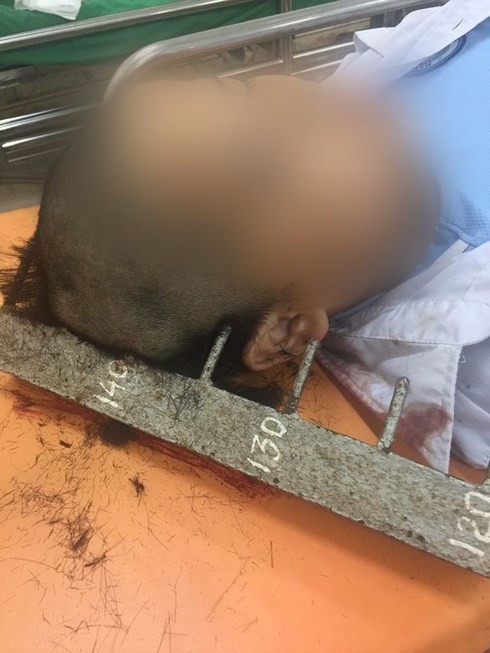 Nam sinh lớp 6 nhập viện do bị đinh xà dọc chọc thủng đầu ảnh 1