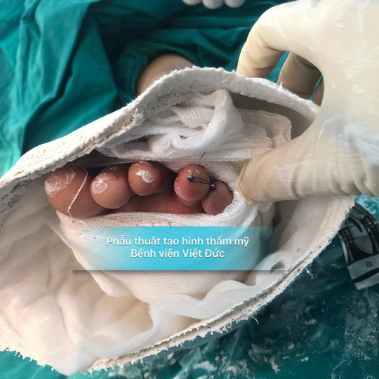 Nối thành công ngón chân đứt rời bằng kỹ thuật siêu vi phẫu ảnh 1