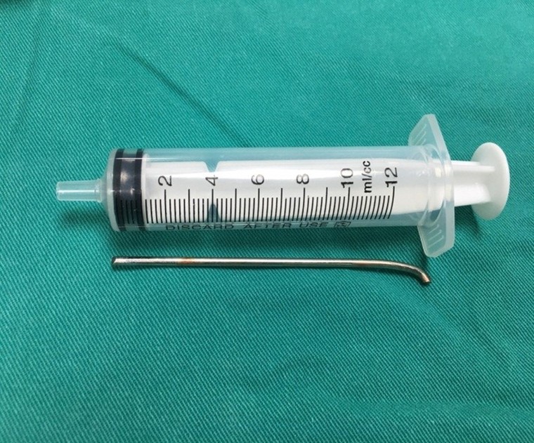 Lấy thành công chiếc đinh di chuyển từ vai xuống phổi một thanh niên 18 tuổi ảnh 1