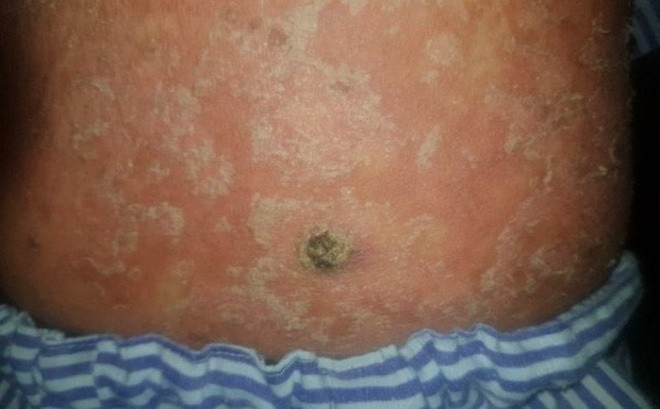 Uống ‘thuốc gia truyền’ chứa arsen, nam thanh niên mắc ung thư ảnh 1