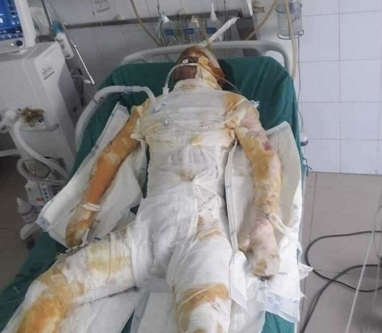 Sập lò tại công ty gang thép, 3 công nhân bỏng nặng ảnh 1