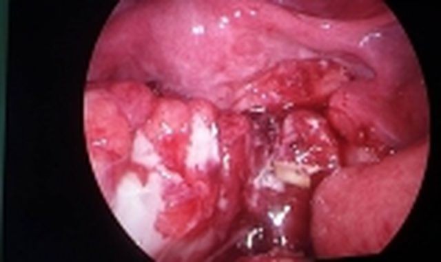 Nuốt phải xương gà trong buổi liên hoan, một trẻ 12 tuổi bị thủng ruột ảnh 1