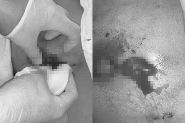 Ngực phình to, chảy máu mủ vì tiêm chất làm đầy ảnh 1