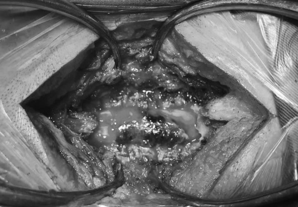 Người phụ nữ suýt phải ngồi xe lăn suốt đời vì đi giác hơi, bấm huyệt ảnh 2