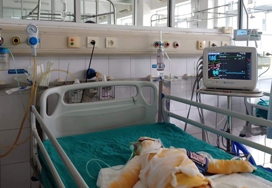 Ba trẻ mầm non bị bỏng cồn đã có chuyển biến khả quan về sức khỏe ảnh 1