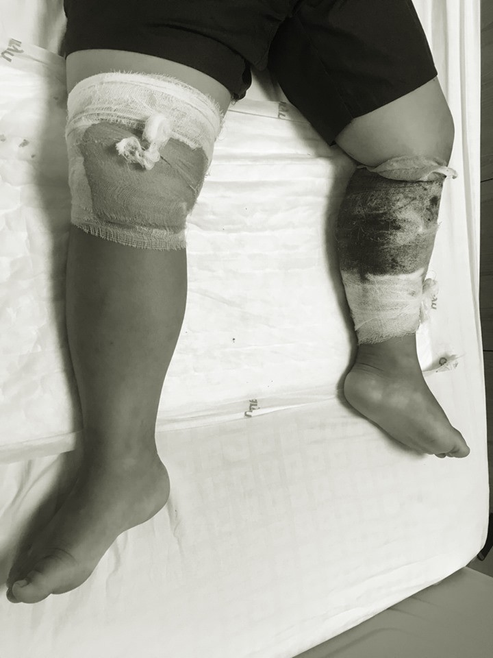 Phú Thọ: Bé trai 7 tuổi bị chó lai nặng 30 kg cắn nát chân ảnh 1