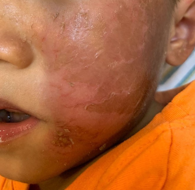 Đeo mặt nạ hóa trang Halloween, bé trai 4 tuổi bị phồng rộp da mặt ảnh 1