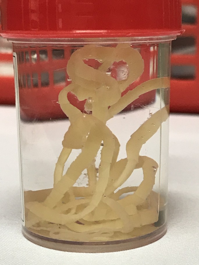 Người đàn ông bị nhiễm sán dây dài hơn 1m vì thói quen ăn bò tái ảnh 1