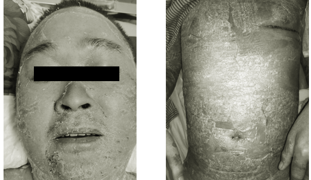 Người đàn ông bị mụn mủ toàn thân do chữa vảy nến bằng cách đắp thuốc nam ảnh 1