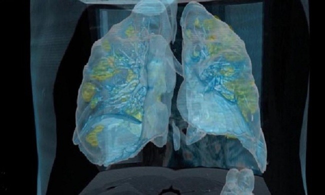 Hình ảnh thực tế ảo lá phổi nhiễm nCoV ảnh 1