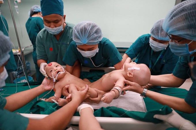 Tách thành công cặp song sinh dính liền ảnh 7