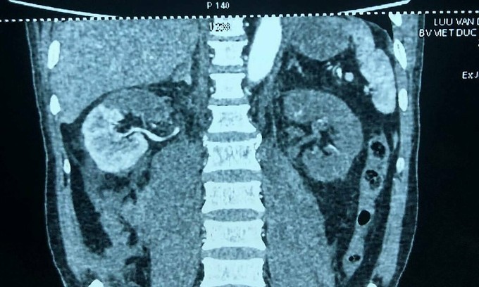 Cứu sống người bị tai nạn giao thông nhờ cắt thận ra rửa rồi ghép lại ảnh 1