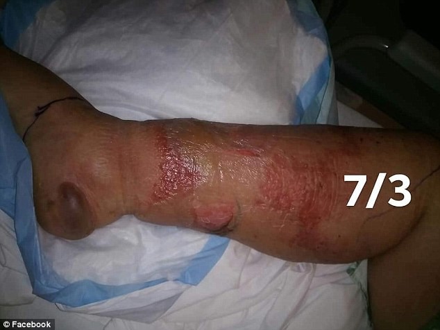 Without antibiotic treatment, cellulitis can be life-threatening and can require amputation