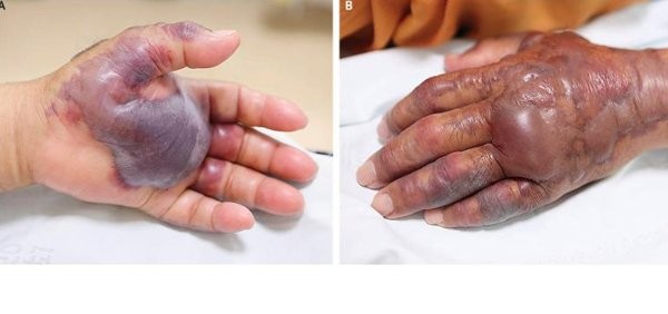 Người đàn ông bị cắt cụt tay vì món ăn tươi sống nhiều người yêu thích